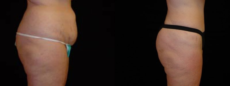 Tummy Tuck