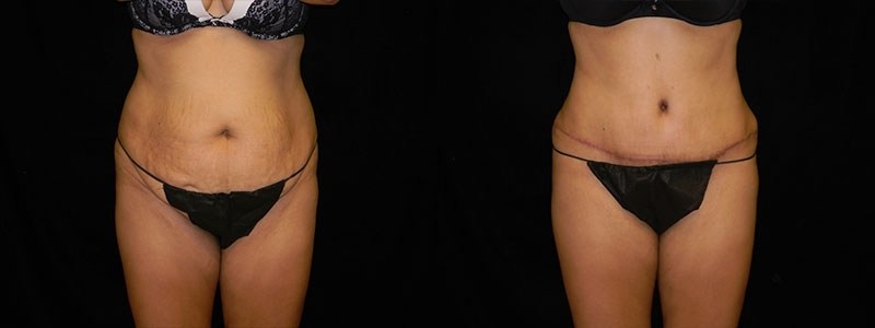 Tummy Tuck