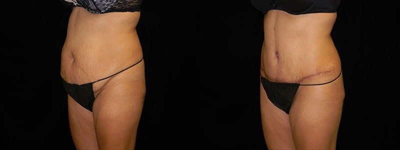 Tummy Tuck