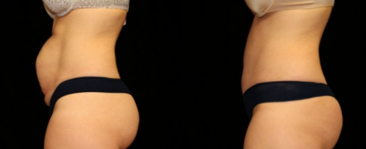 Tummy Tuck