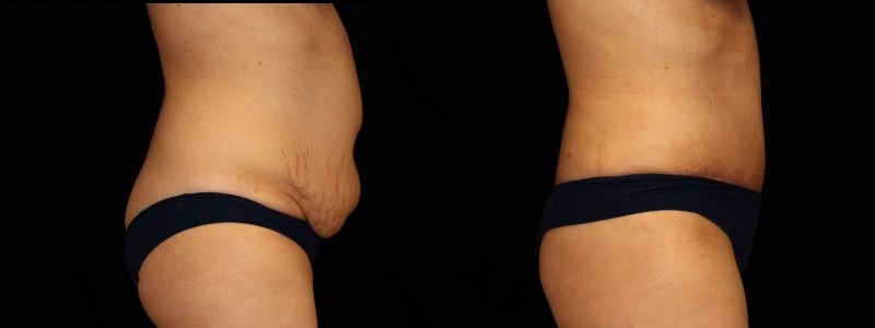 Tummy Tuck