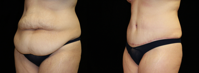 Tummy Tuck
