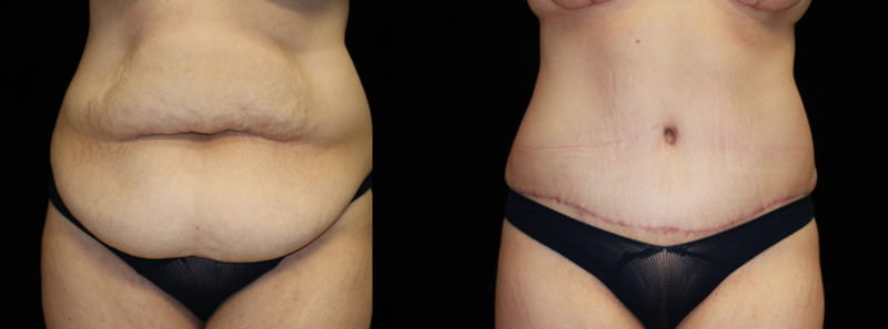 Tummy Tuck
