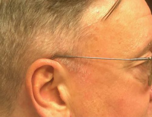 The Doctor Becomes the Patient: Dr. Slack’s Experience with Neograft Hair Restoration