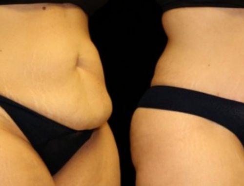 Loose Skin after Weight Loss. Now What?