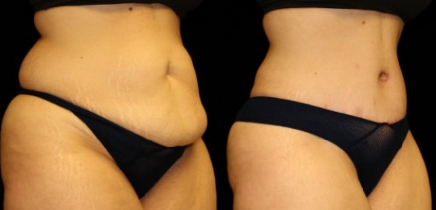 Reverse Tummy Tuck Before and After - Plano Plastic Surgery
