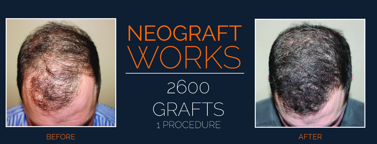 Neograft Hair Transplants - Dr. Slack