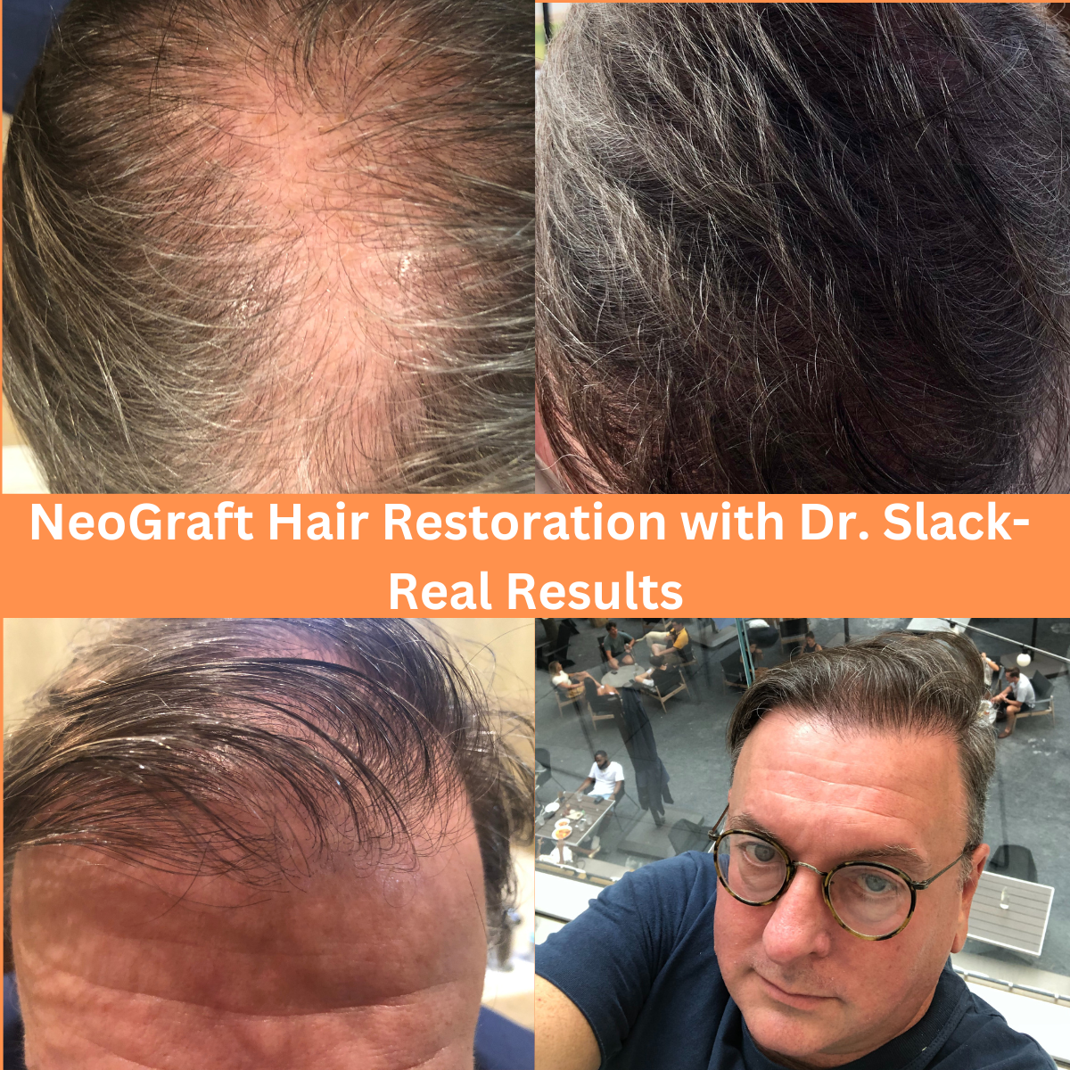 Neograft Before and After