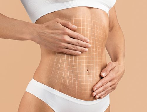 Will I Have Pain After a Tummy Tuck?