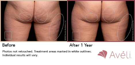 Avéli ™ Long- Term Cellulite Reduction Procedure