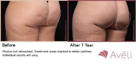 Avéli ™ Long- Term Cellulite Reduction Procedure