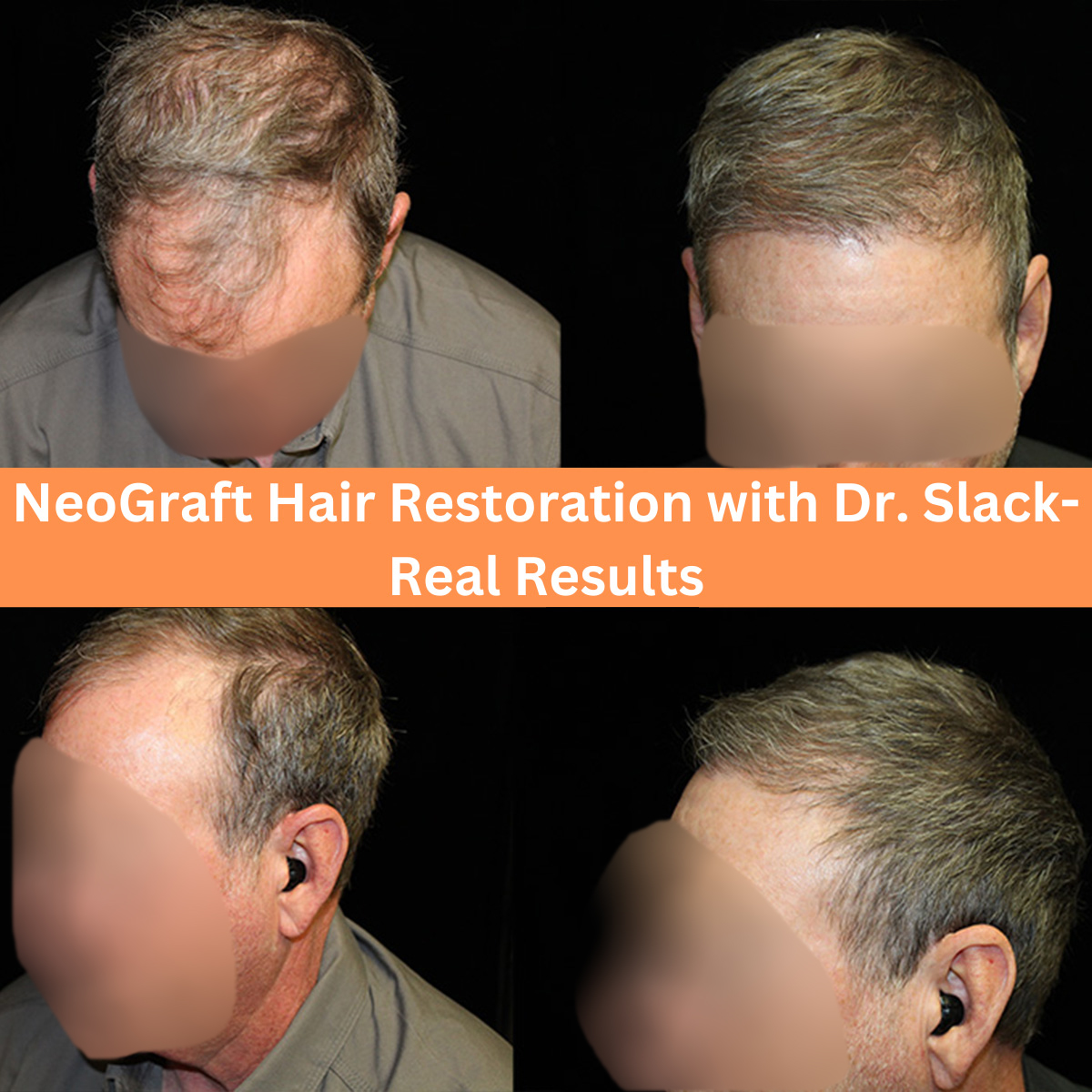 Neograft Before and After